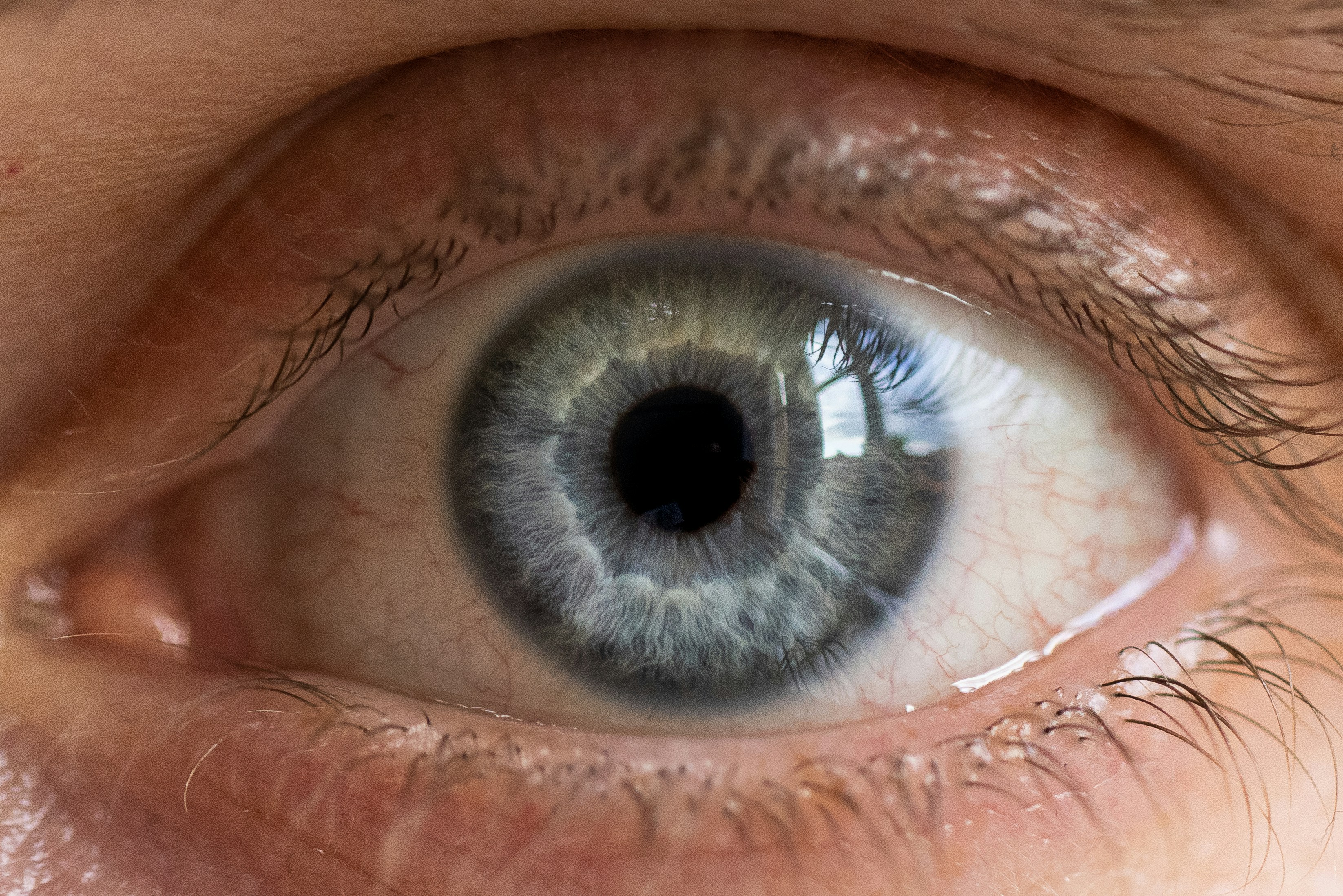 Hypertension of Eye: See and Avoid